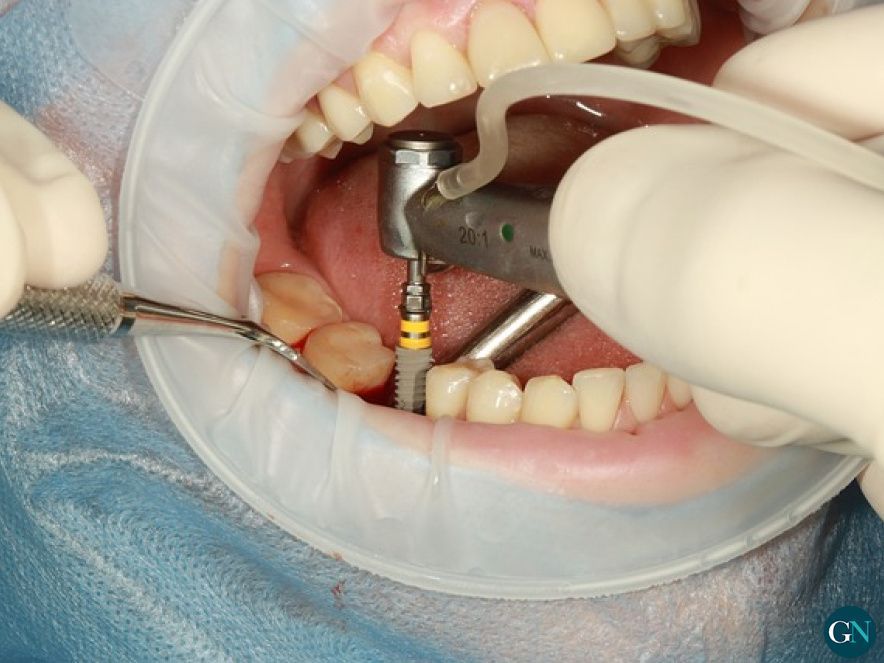 Implantes 